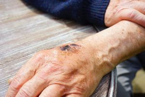 An elderly person's hand with a sore on it